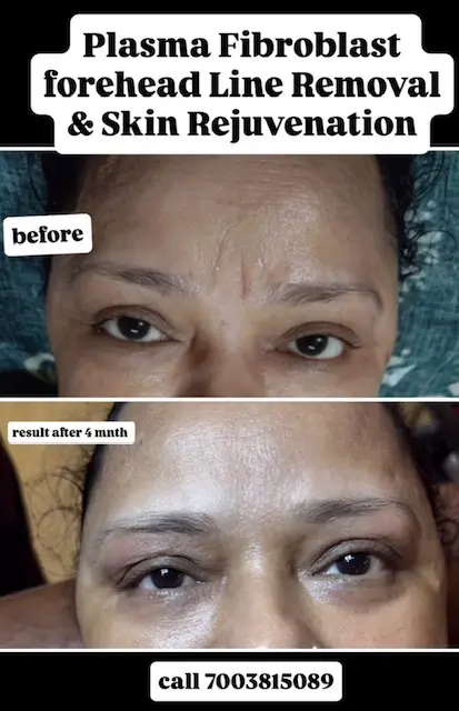 Botox treatment at 3sixty Studio