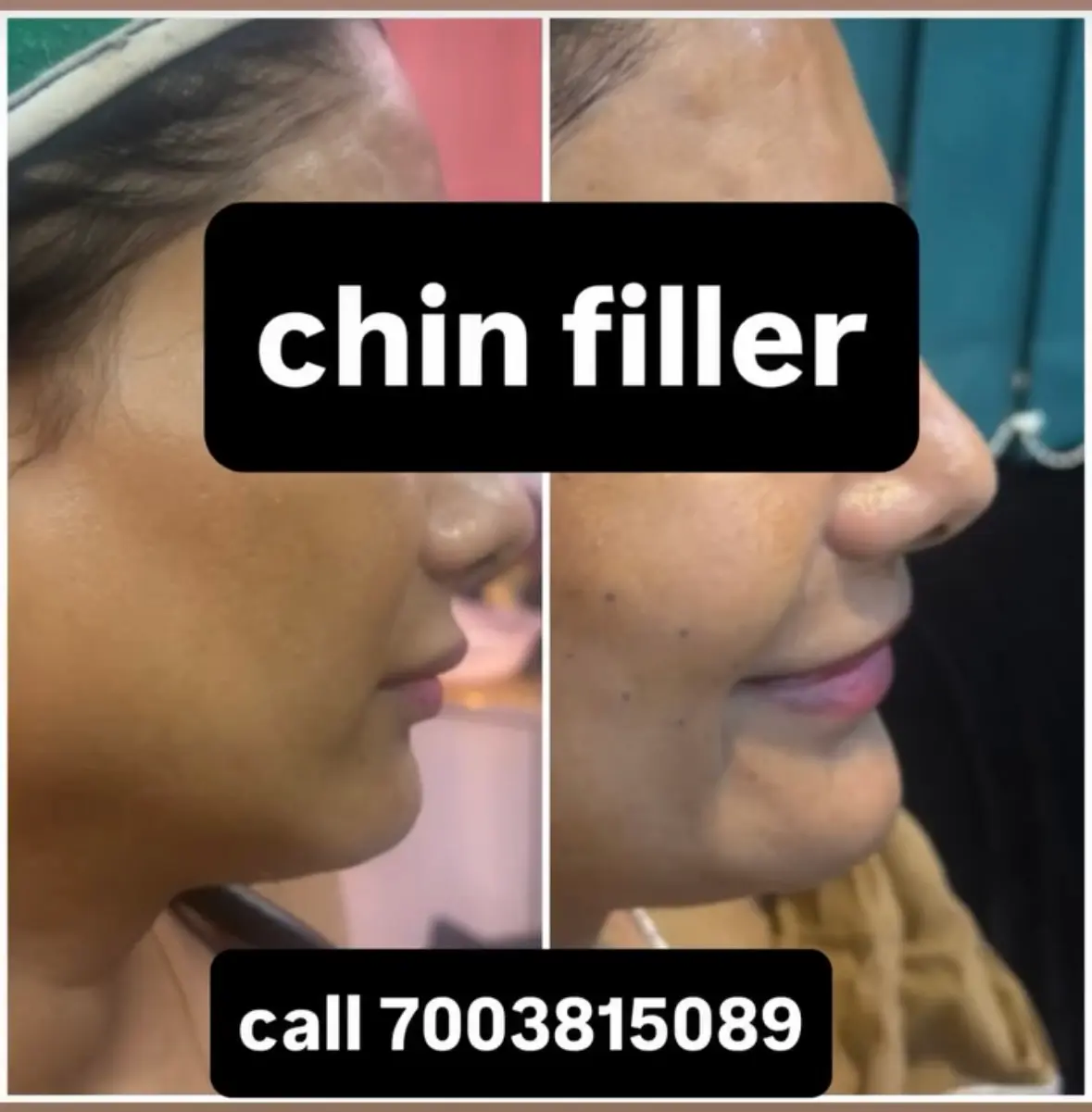 Chin filler treatment at 3sixty Studio