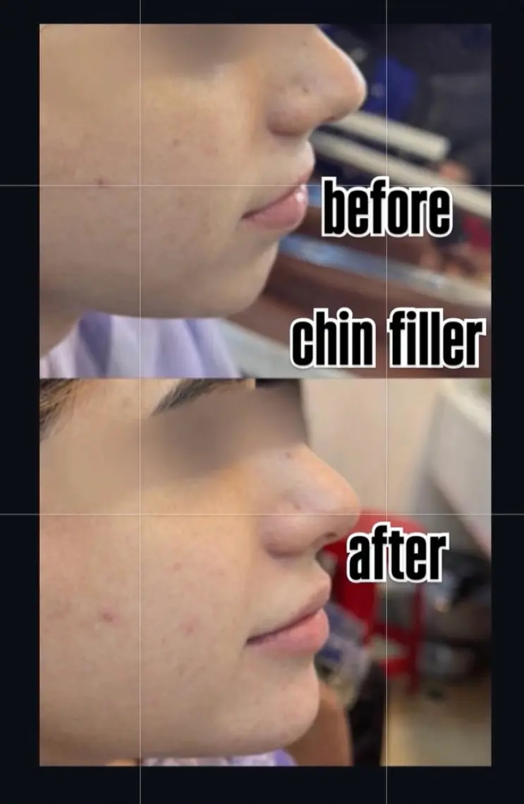 Chin filler treatment at 3sixty Studio