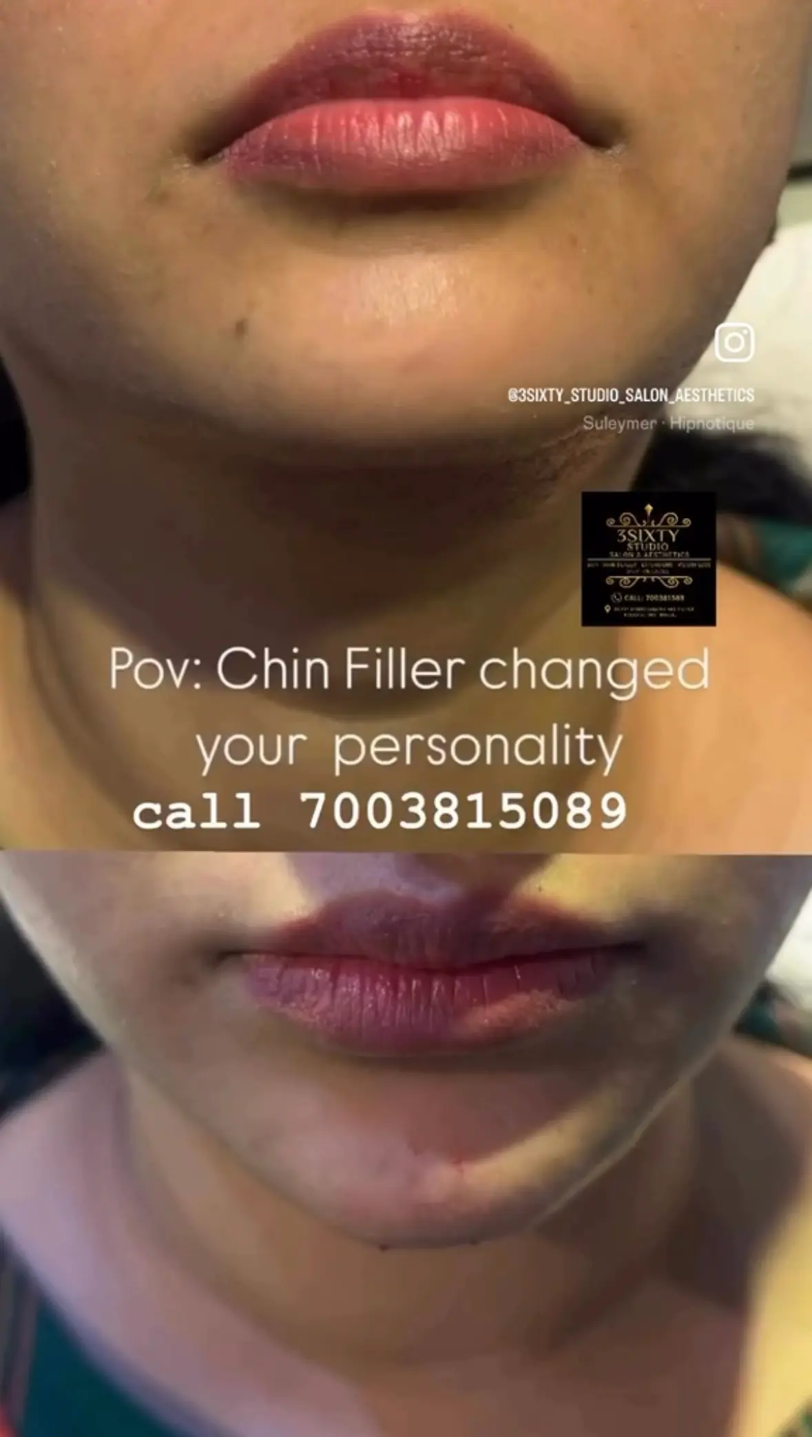 Chin treatment at 3sixty Studio