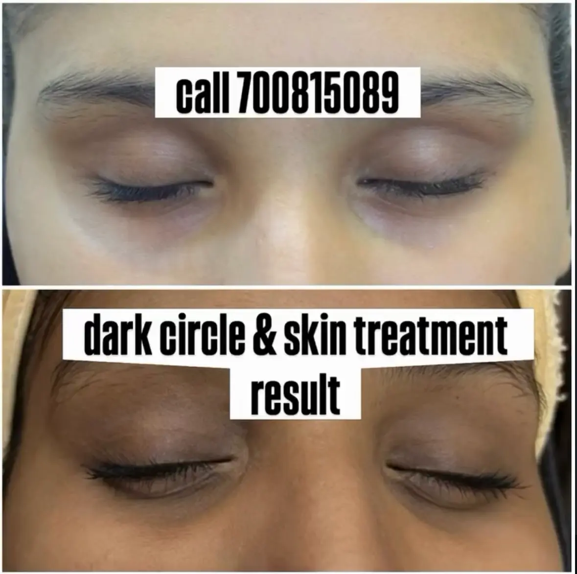 Dark circle treatment at 3sixty Studio
