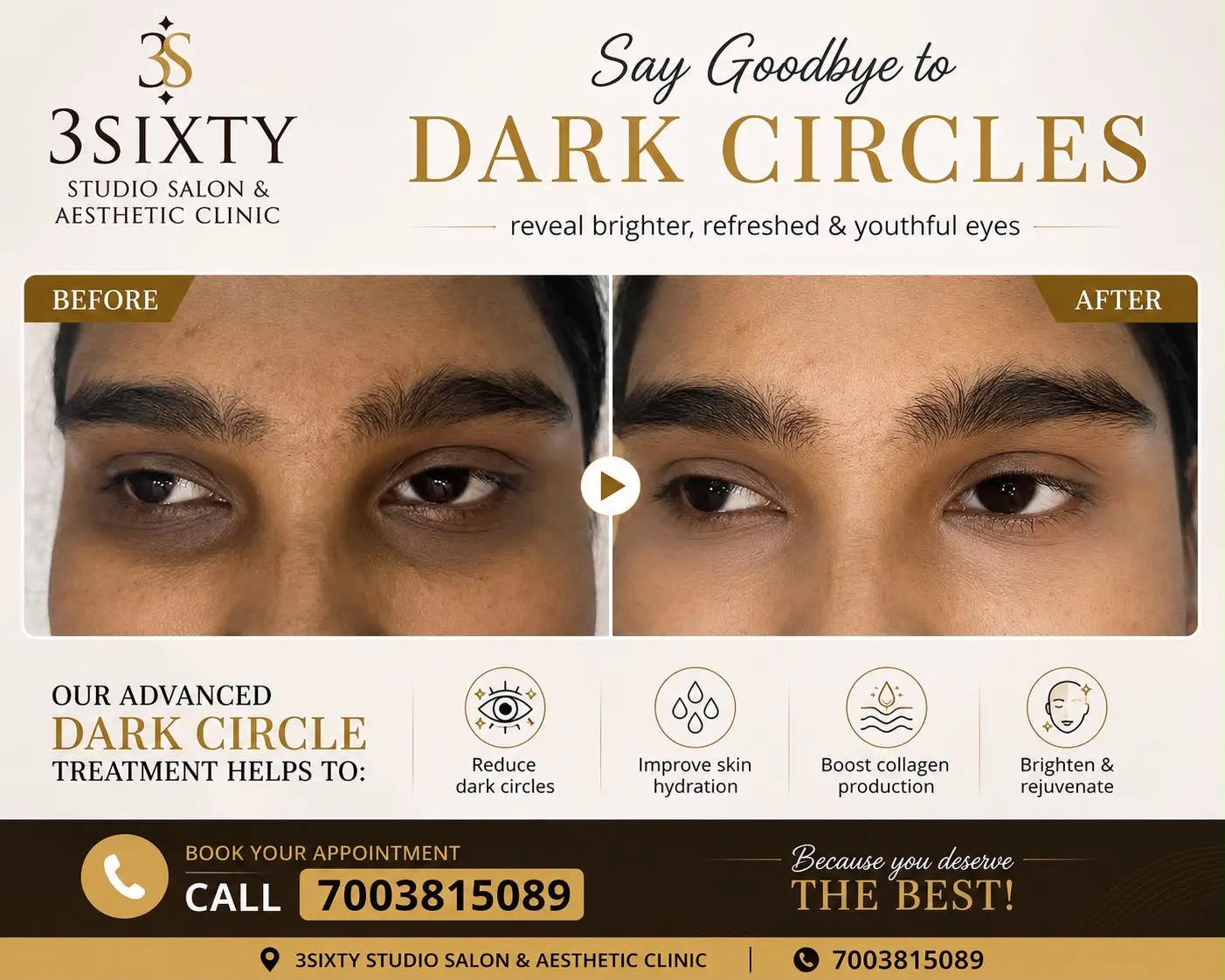 Dark circle treatment at 3sixty Studio