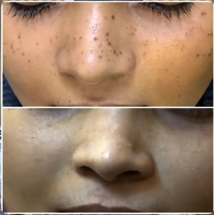 Freckle removal treatment at 3sixty Studio