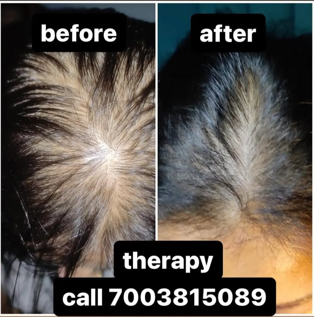 Hair PRP treatment at 3sixty Studio