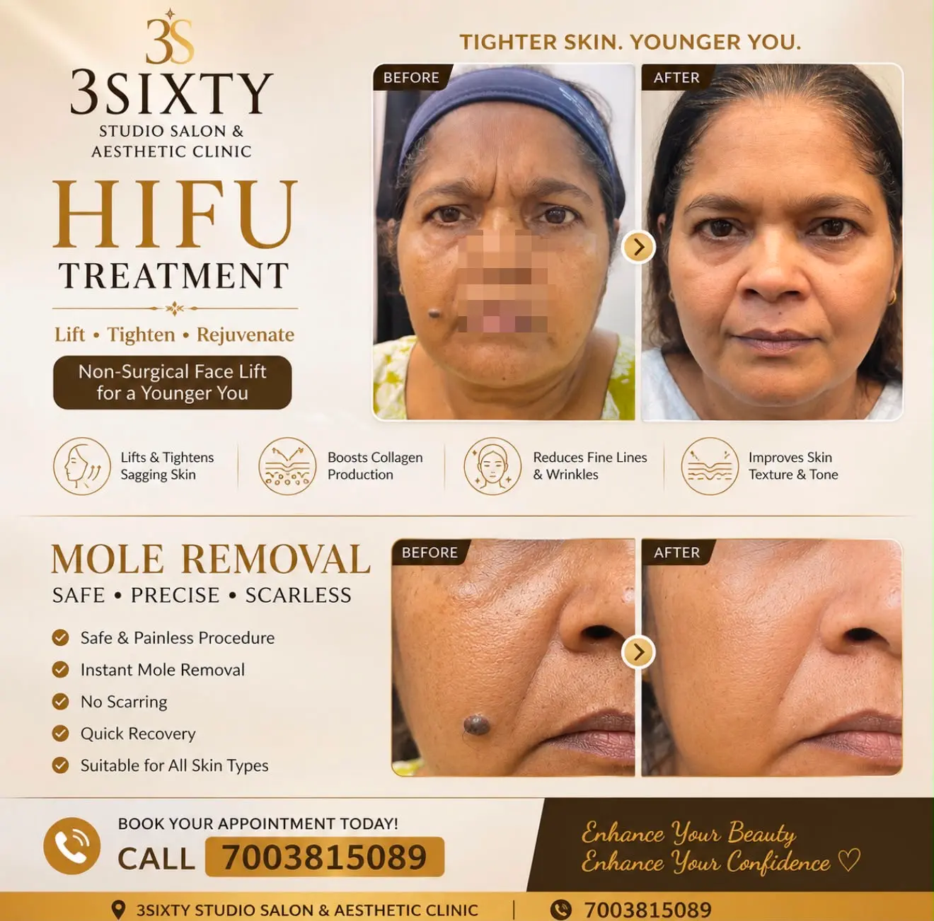 HIFU treatment at 3sixty Studio