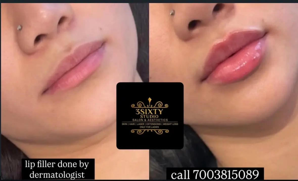 Lip filler treatment at 3sixty Studio