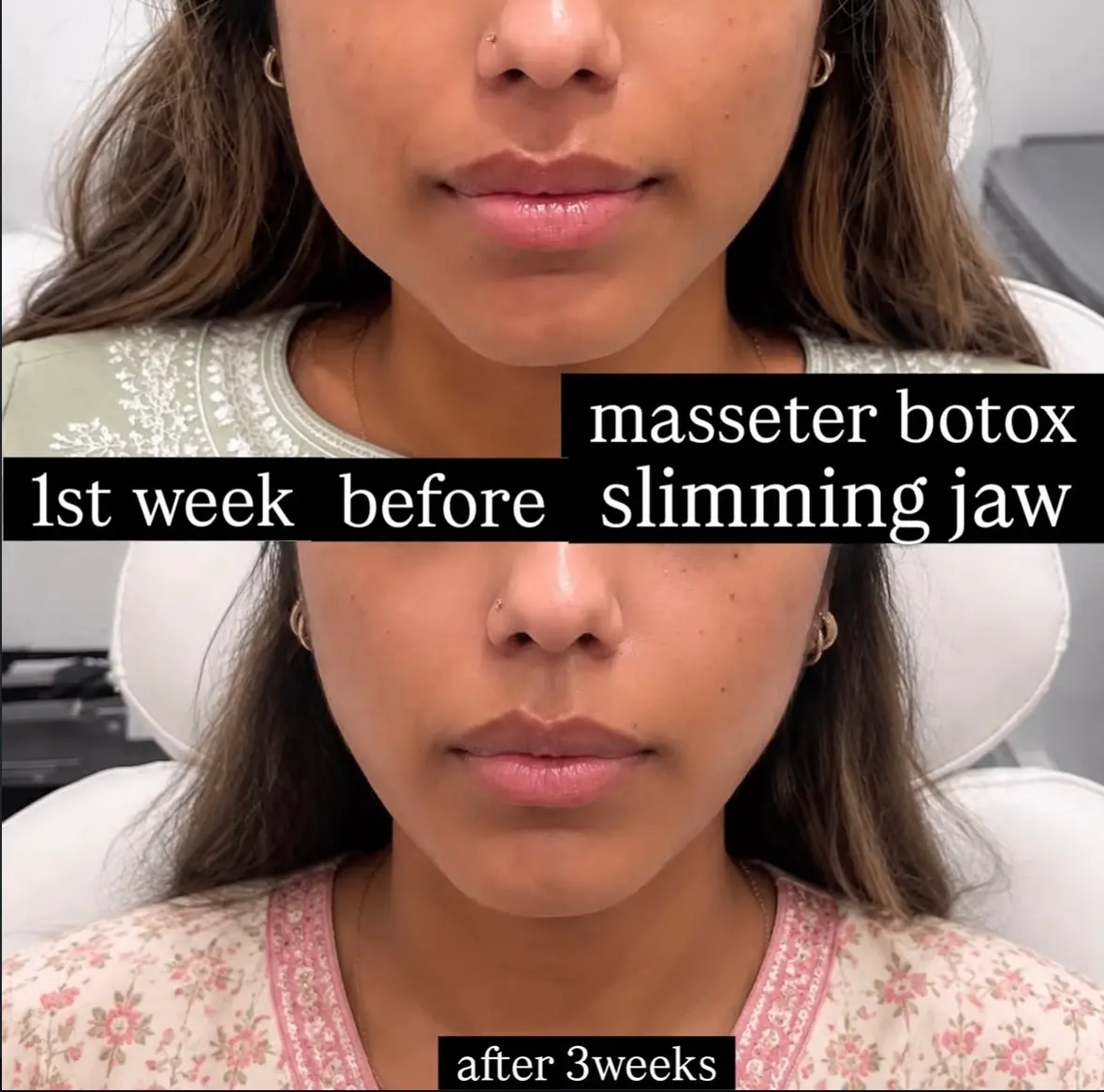 Masseter Botox treatment at 3sixty Studio
