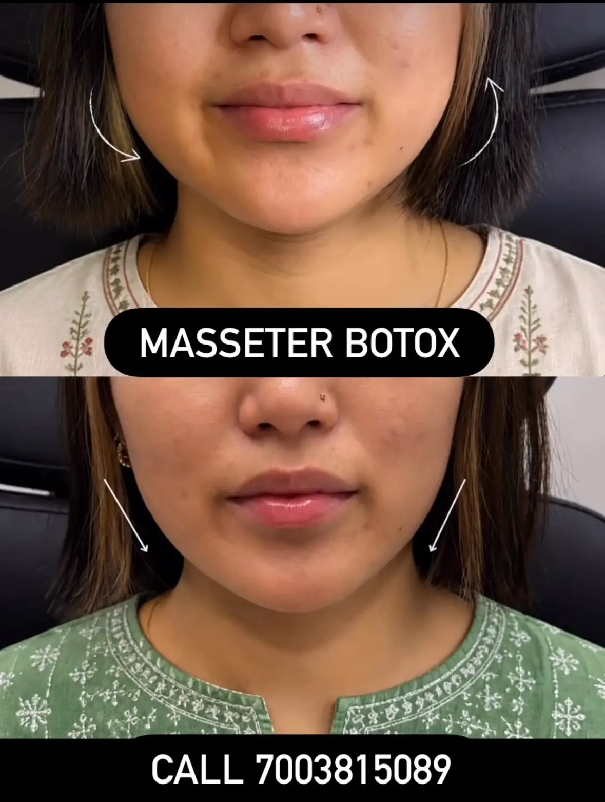 Masseter Botox jawline treatment at 3sixty Studio