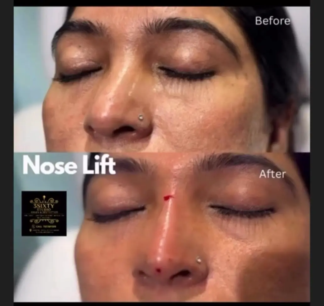 Non-surgical nose lift at 3sixty Studio