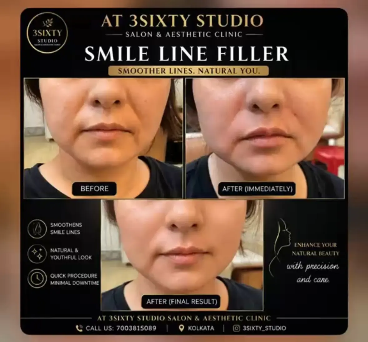 Smile line treatment at 3sixty Studio