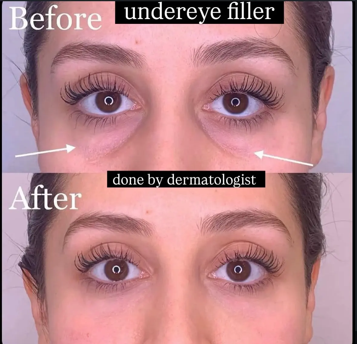 Under-eye filler treatment at 3sixty Studio