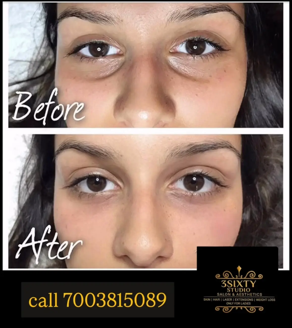 Under-eye filler treatment at 3sixty Studio