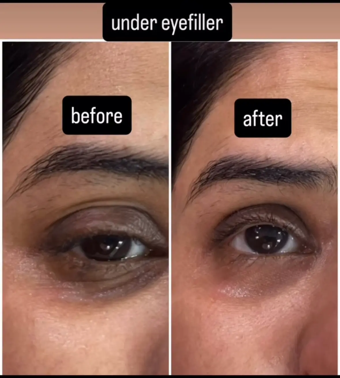 Under-eye filler treatment at 3sixty Studio
